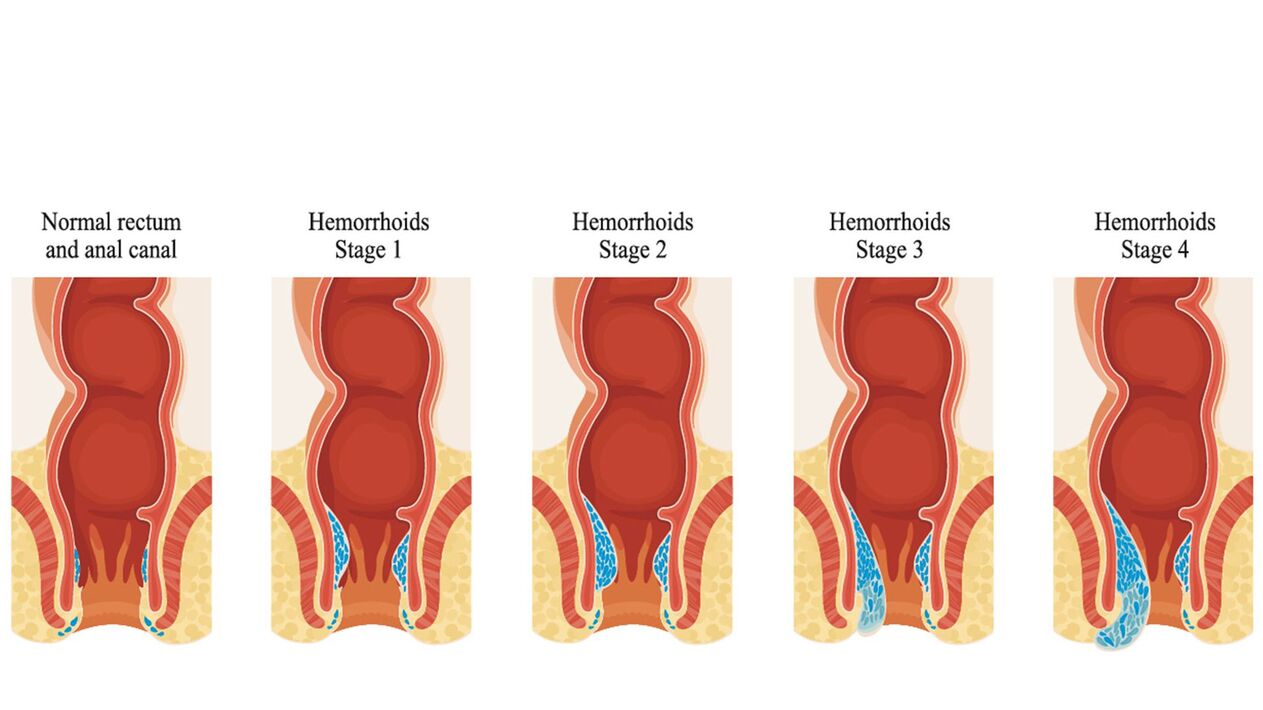 hemorroide motak